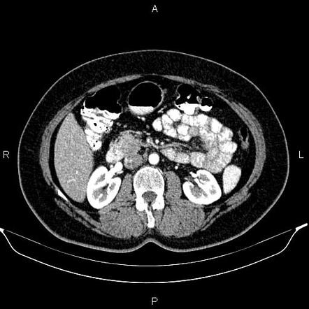 Whipple procedure | Radiology Case | Radiopaedia.org