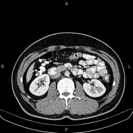 Retrocaval ureter - type 1 | Image | Radiopaedia.org