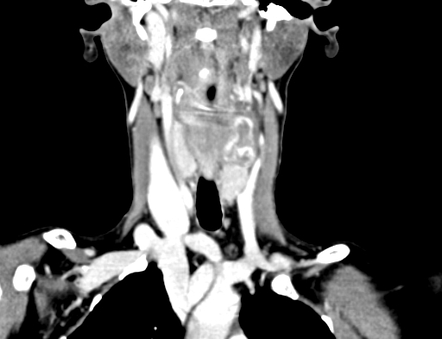 Parathyroid adenoma with brown tumours | Radiology Case | Radiopaedia.org