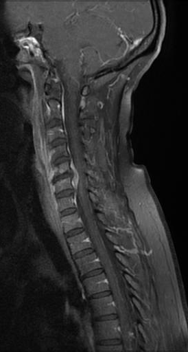 Brucella spondylodiscitis - cervical | Image | Radiopaedia.org