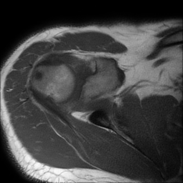 Supraspinatus Calcific Tendinitis With Intraosseous Extension Image