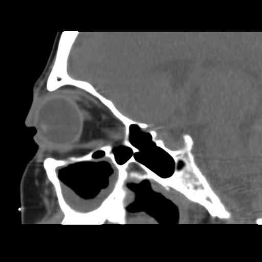 Recurrent dacryoadenitis | Image | Radiopaedia.org