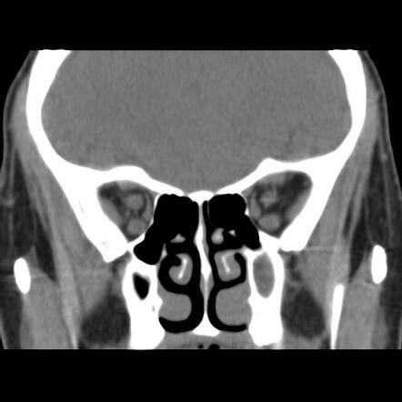 Recurrent Dacryoadenitis | Image | Radiopaedia.org