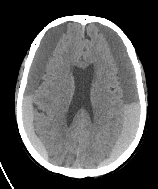 Bilateral subdural hematomas | Image | Radiopaedia.org