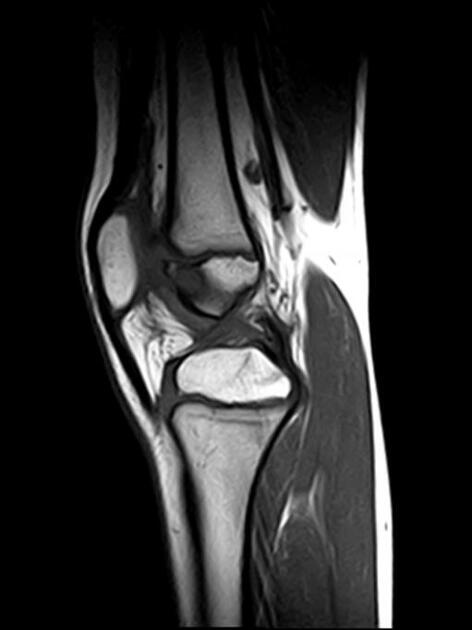 Brodie abscess Radiology Case Radiopaedia