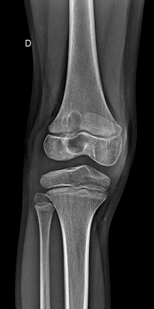 Brodie abscess Radiology Case Radiopaedia