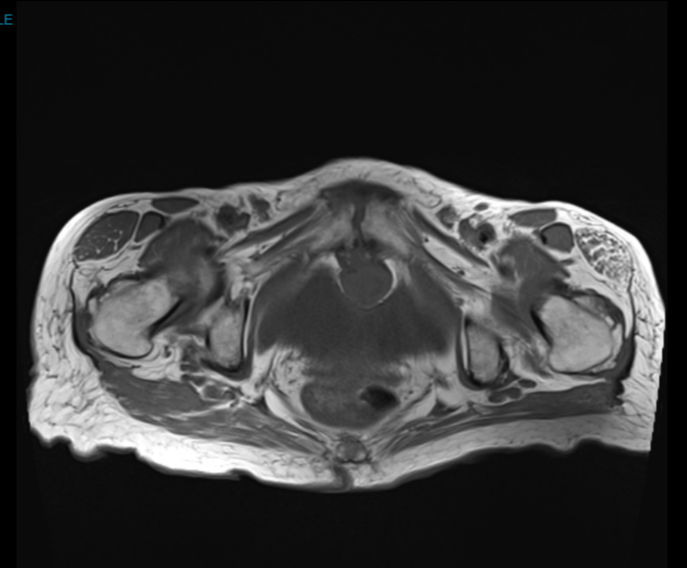 Suprapubic cartilaginous cyst | Image | Radiopaedia.org