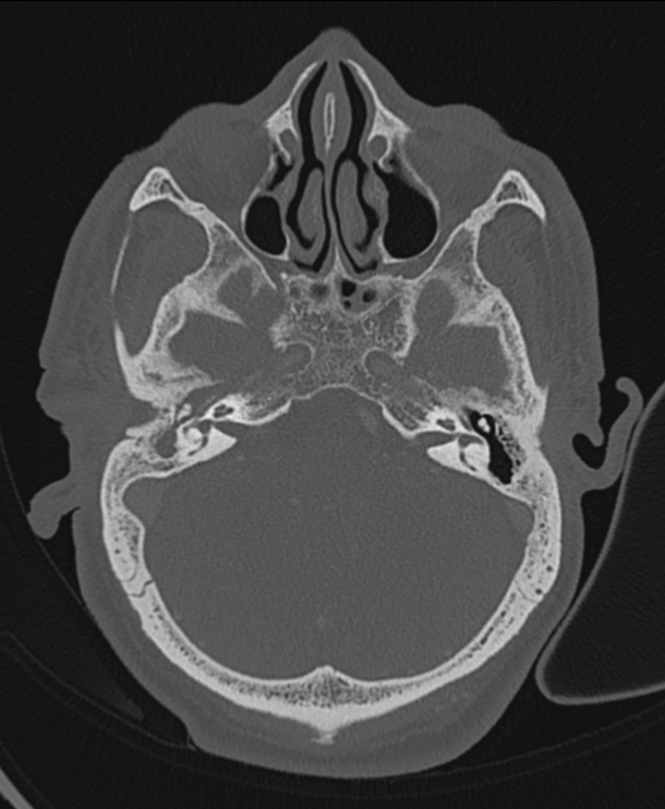 Necrotizing otitis externa | Image | Radiopaedia.org