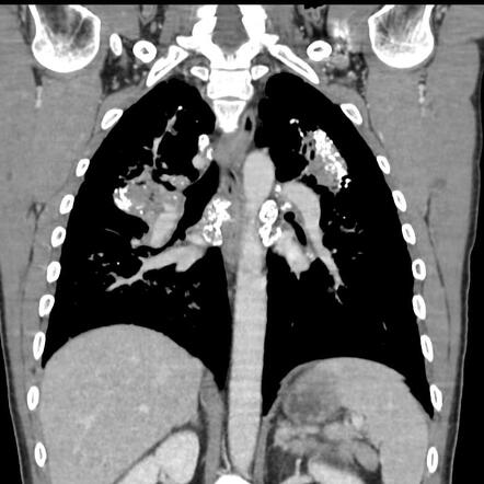 Silicosis | Radiology Reference Article | Radiopaedia.org