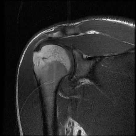 Anterior glenohumeral instability - Hill-Sachs defect and Bankart ...