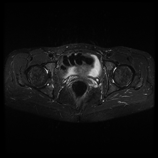 Acetabular intraosseous lipoma | Image | Radiopaedia.org