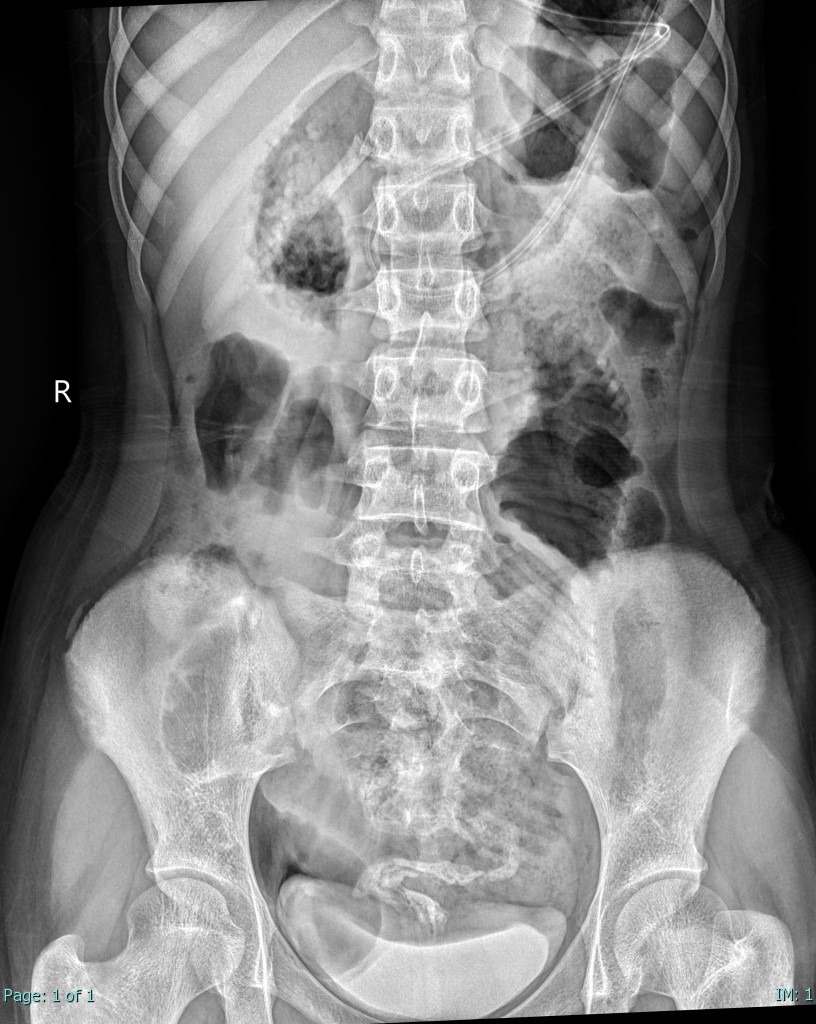 Dilated small bowel (suspected bowel obstruction) | Image | Radiopaedia.org