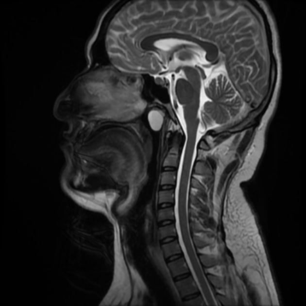 Tornwaldt cyst | Image | Radiopaedia.org