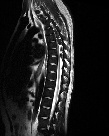 Extramedullary Haematopoiesis - Spinal Epidural Lesions | Radiology ...