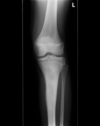 Ewing sarcoma | Radiology Case | Radiopaedia.org