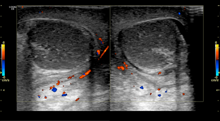 Global Testicular Infarction Radiology Case Radiopaedia Org