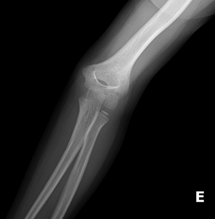 Supracondylar fracture - Gartland type I | Image | Radiopaedia.org