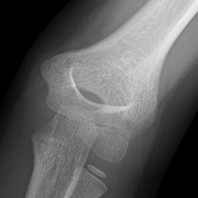 Supracondylar fracture - Gartland type I | Image | Radiopaedia.org