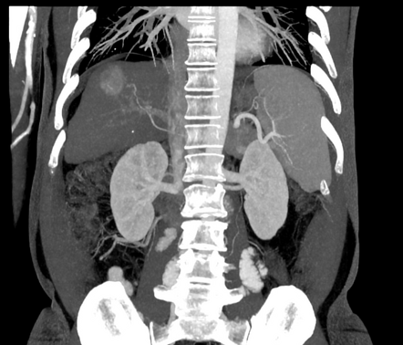 Hepatocellular carcinoma | Radiology Case | Radiopaedia.org