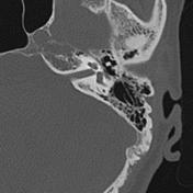 Radiopaedia - Drawing Middle ear ossicles: malleus, incus and