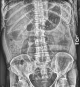 Emphysematous cholecystitis | Radiology Reference Article | Radiopaedia.org