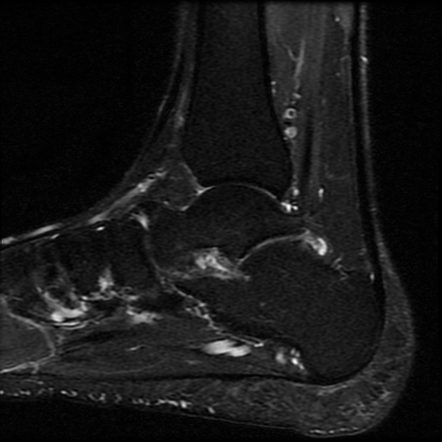 Fibrous talocalcaneal coalition | Image | Radiopaedia.org