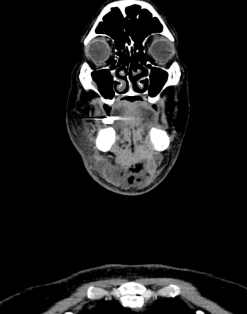 Ludwig angina | Radiology Case | Radiopaedia.org