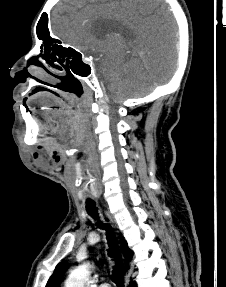 Ludwig Angina Image