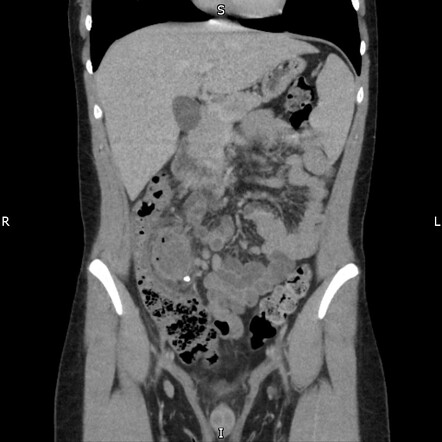 Perforated appendicitis | Radiology Case | Radiopaedia.org