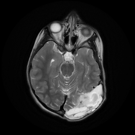 Growing skull fracture | Radiology Case | Radiopaedia.org