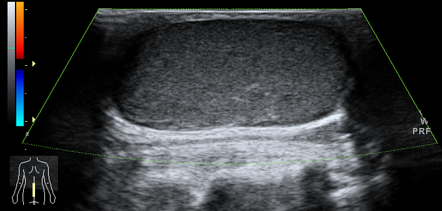 the classic ultrasound presentation of an epidermoid cyst is