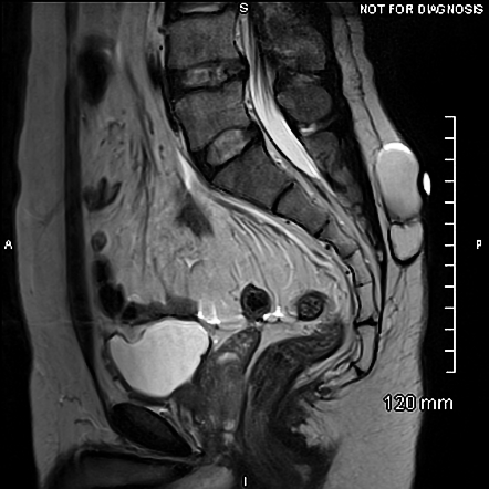 Epidermoid cyst | Radiology Case | Radiopaedia.org