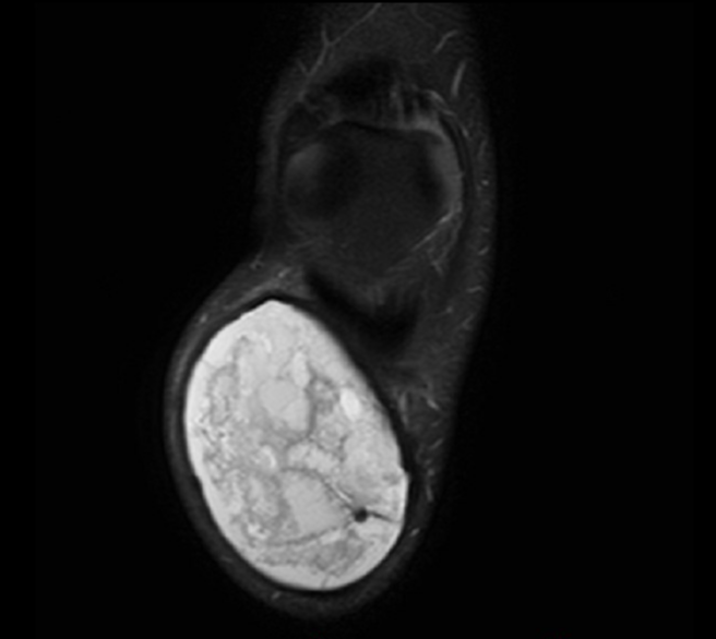 Hemorrhagic superficial infrapatellar bursitis | Image | Radiopaedia.org