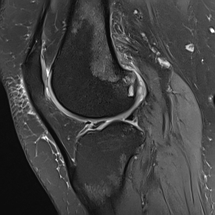 Anterior and posterior cruciate ligaments mucoid degeneration with ...