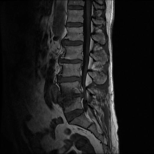 Modic type 1 end plate changes with foraminal disc extrusion | Image ...