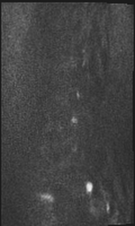 Modic type 1 end plate changes with foraminal disc extrusion | Image ...