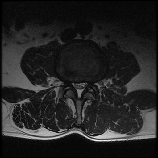 Modic type 1 end plate changes with foraminal disc extrusion | Image ...