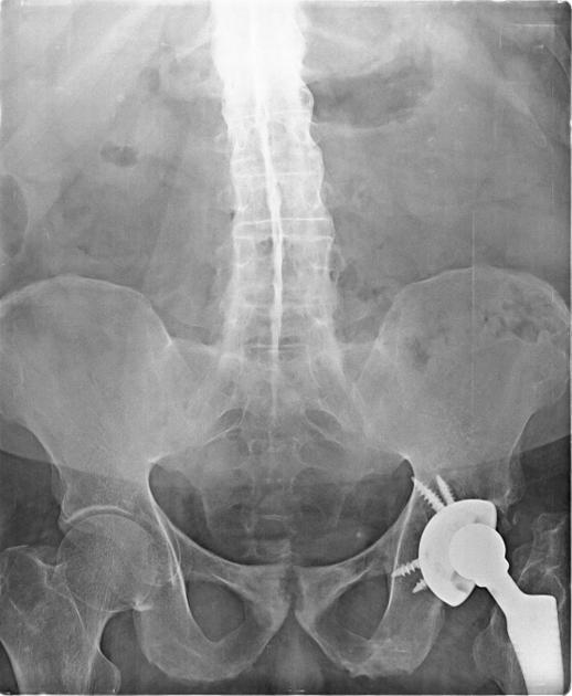 Disease Control Data, Ankylosing Spondylitis