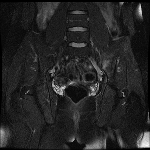 Acute sacroiliitis - unilateral | Image | Radiopaedia.org