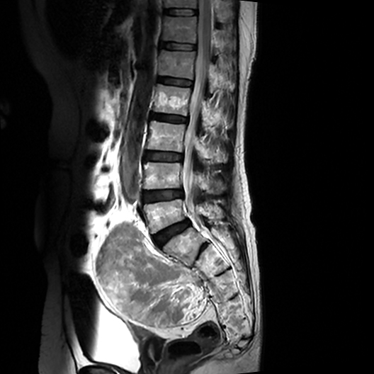 Extramedullary Hematopoiesis - Presacral Soft Tissue Mass | Image ...