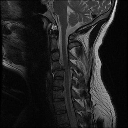 Fracture dislocation C4/5 | Radiology Case | Radiopaedia.org