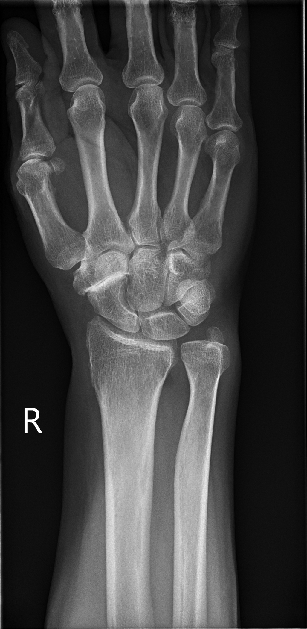 Isolated triscaphe osteoarthritis - bilateral | Image | Radiopaedia.org