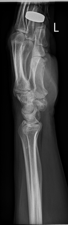 Isolated triscaphe osteoarthritis - bilateral | Image | Radiopaedia.org