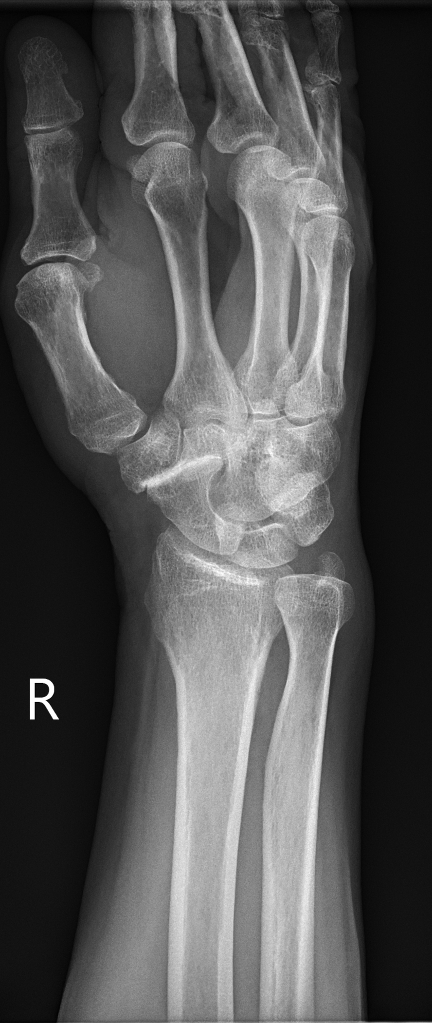 Isolated triscaphe osteoarthritis - bilateral | Image | Radiopaedia.org