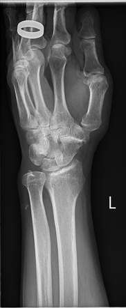 Isolated triscaphe osteoarthritis - bilateral | Image | Radiopaedia.org