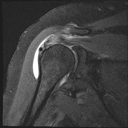 Calcific Tendinitis Of Supraspinatus Tendon Radiology Case