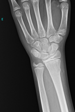 Torus fracture of the radius | Radiology Case | Radiopaedia.org