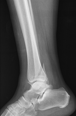 Trimalleolar ankle fracture | Radiology Case | Radiopaedia.org