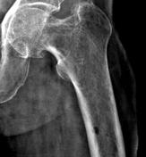 Multiple myeloma | Radiology Reference Article | Radiopaedia.org