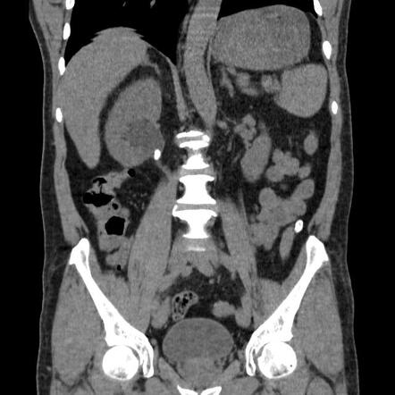 Ureteropelvic junction calculus | Radiology Case | Radiopaedia.org